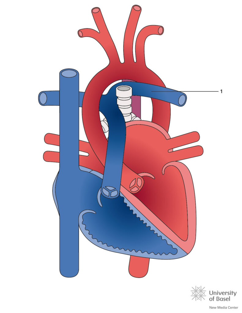Aberrant Left Pulmonary Artery