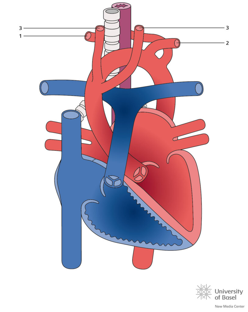 Aberrant Right Subclavian Artery