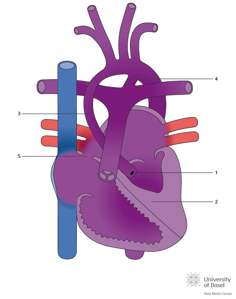 Aortic Atresia And Hypoplastic Left Ventricle