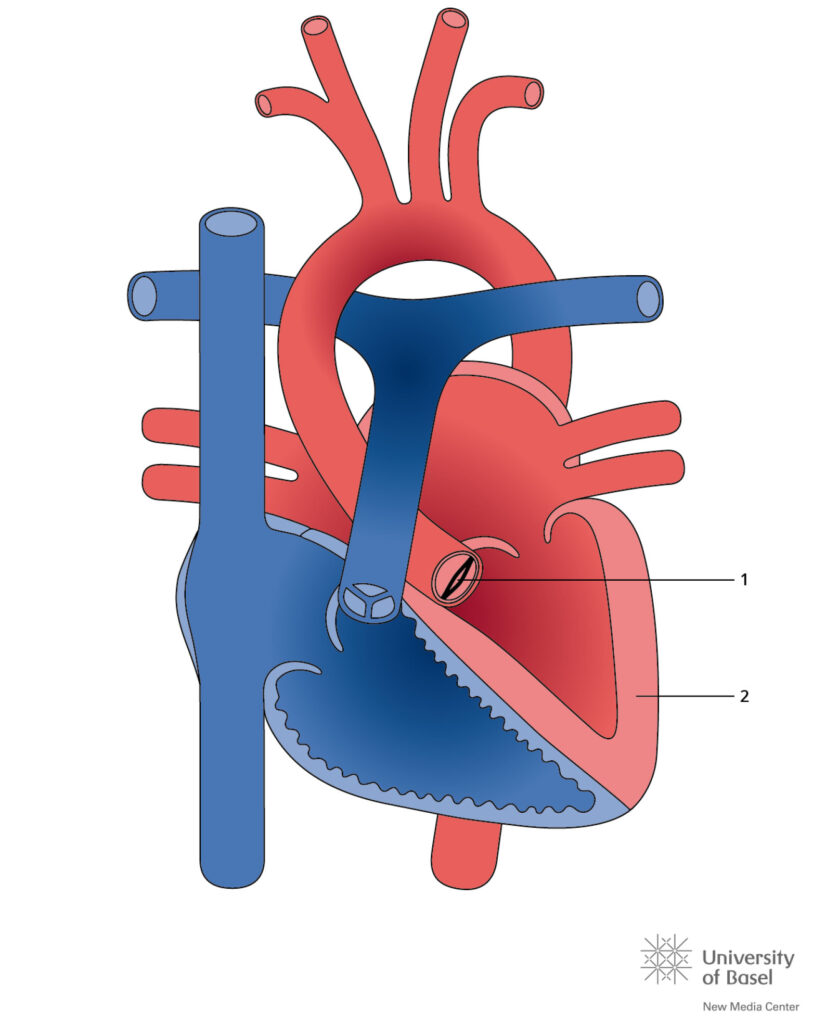 Bicuspid Aortic Valve With Aortic Stenosis