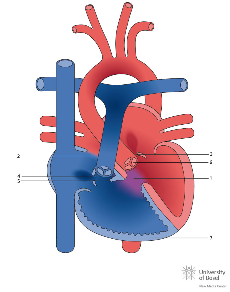 Complete Atrioventricular Septal Defect (avsd) With Tetralogy Of