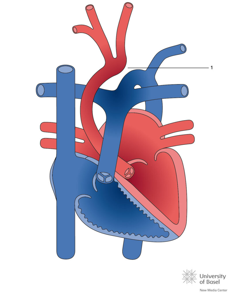 Interrupted Aortic Arch Type Ii
