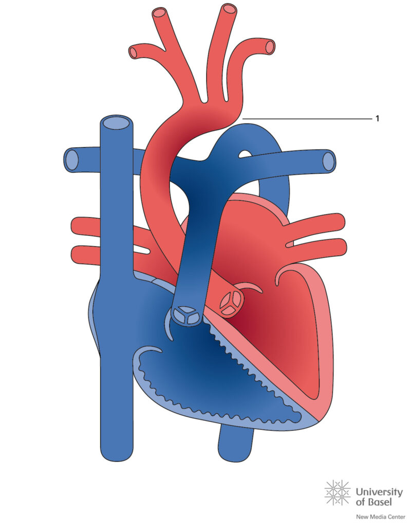 Interrupted Aortic Arch Type I