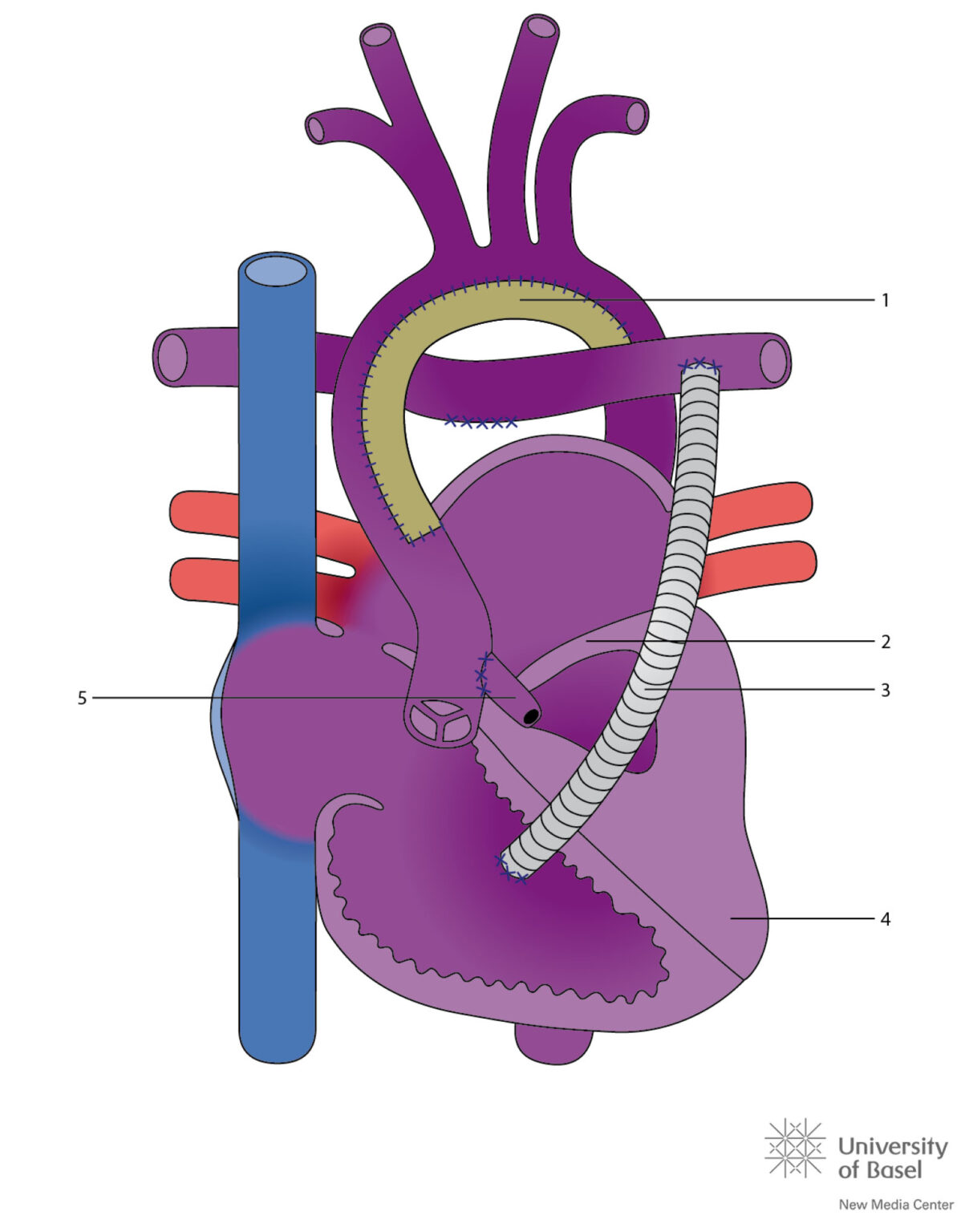 Hypoplastisch Linker Hart Syndroom Cahal