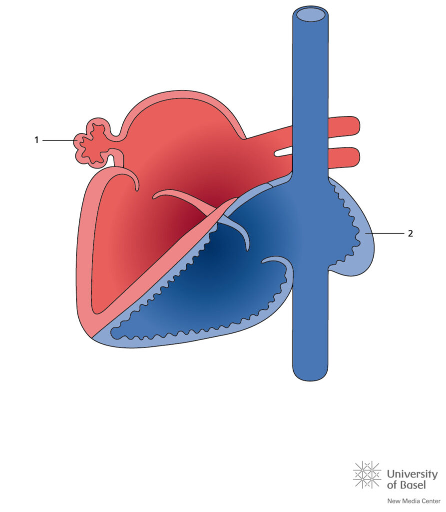 Situs Inversus With Left And Right Atrial Appendices