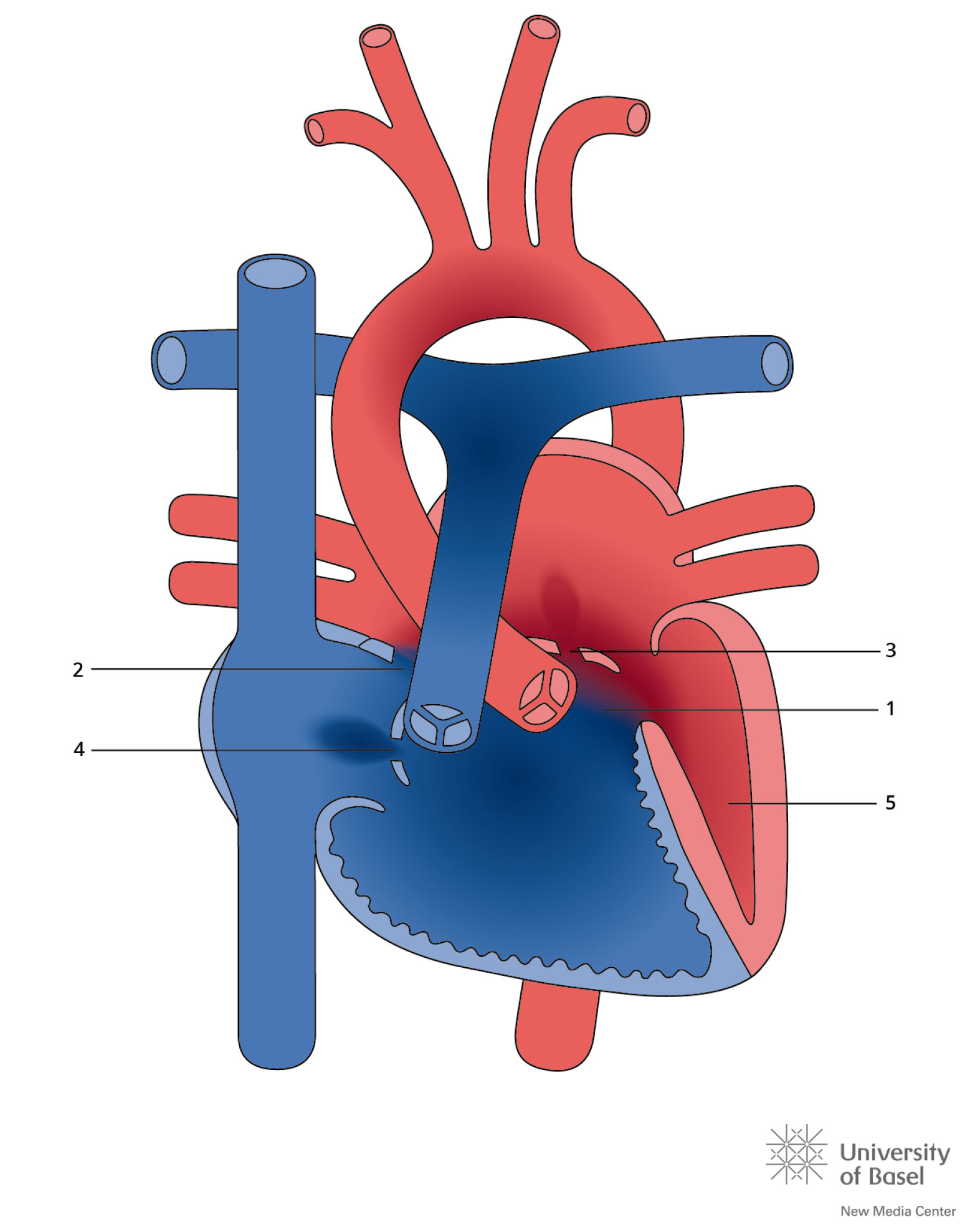 Avsd Defect Types Atrioventriculair septum defect – CAHAL
