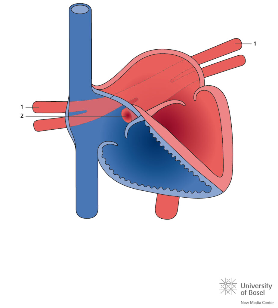 Total Anomalous Pulmonary Venous Connection (tapvc); Cardiac Typ