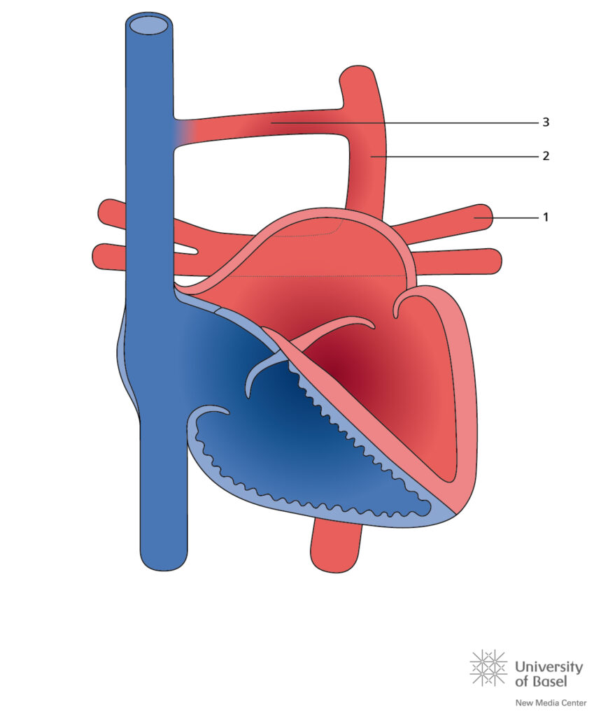 Total Anomalous Pulmonary Venous Connection (tapvc); Supracardia
